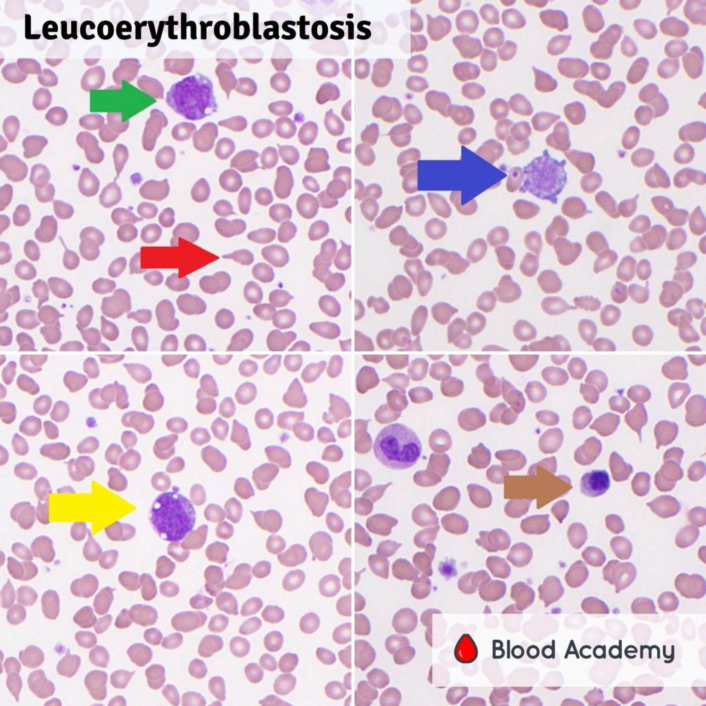 Leucoerythroblastosis
