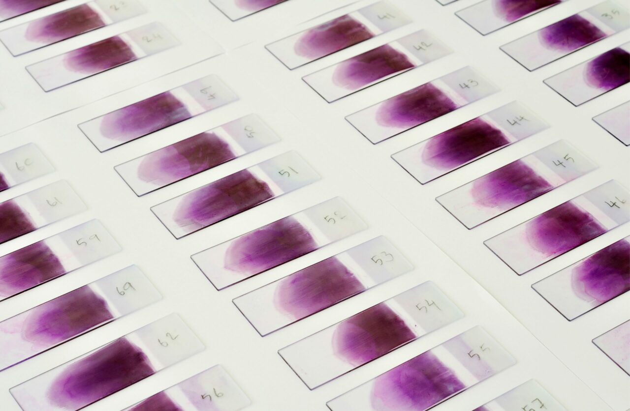 Morphologic Clues to Underlying Genetic Alterations in Myeloid Malignancies